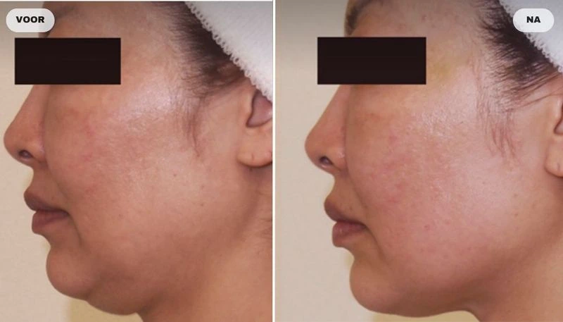 Before and after photo of cheek and jawline with RF skin tightening, before left and after right