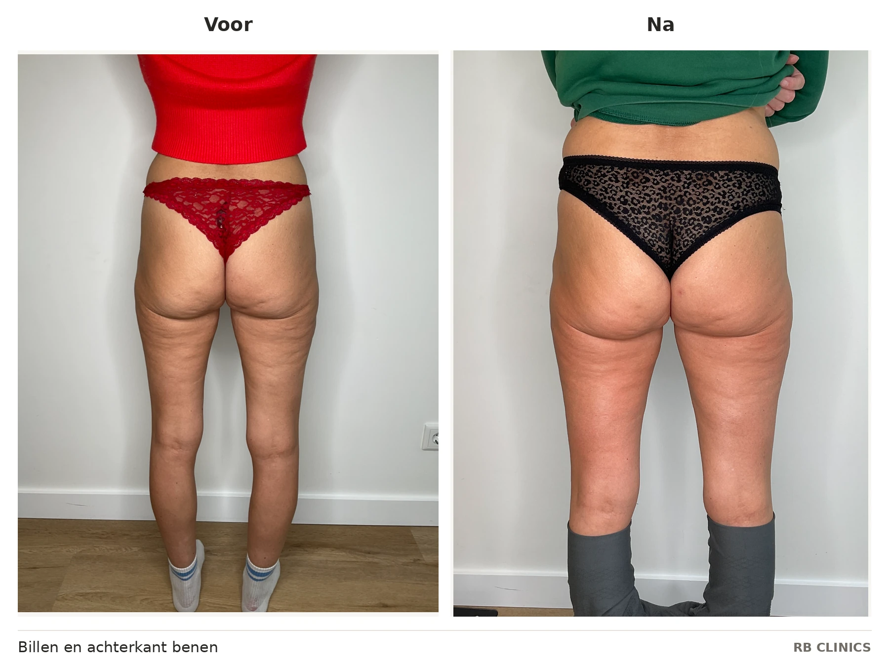 Before and after photo of buttocks and back of legs with RF skin tightening, before left and after right