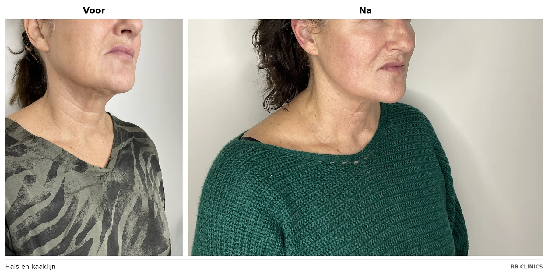 Before and after photo of neck and jawline with RF skin tightening, before left and after right