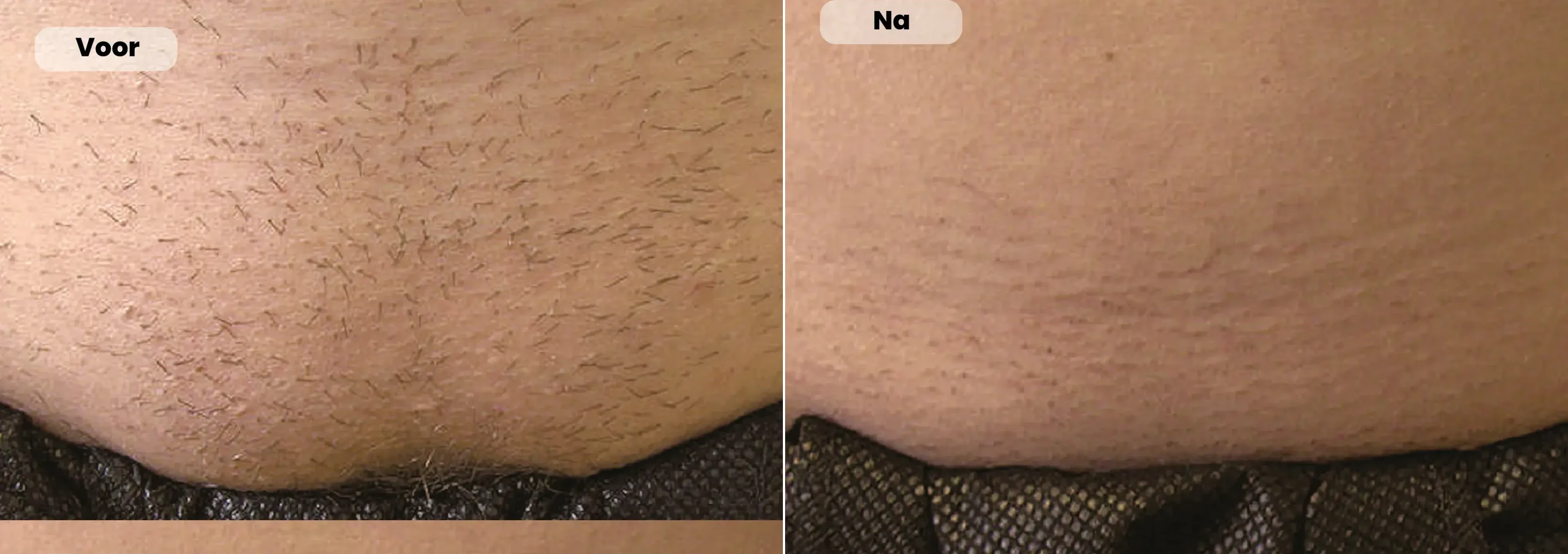 Before / After: Abdomen, Laser hair removal | RB Clinics