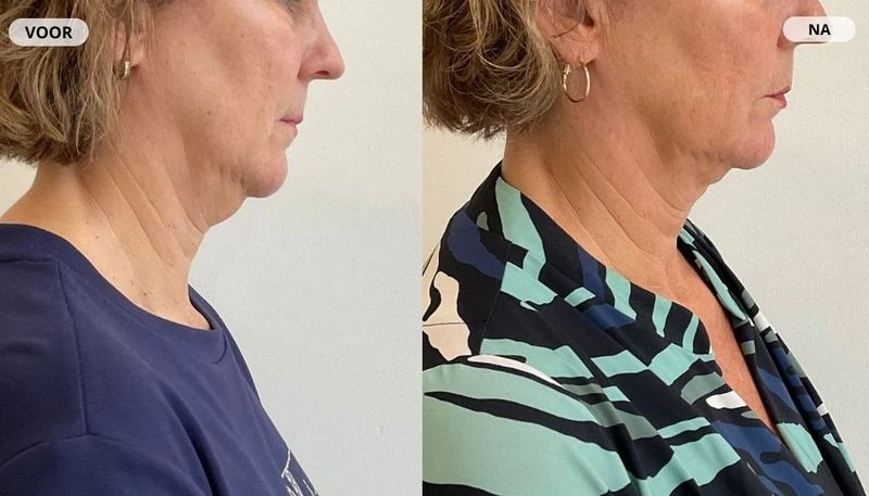 Before and after result from fat freezing at RB Clinics