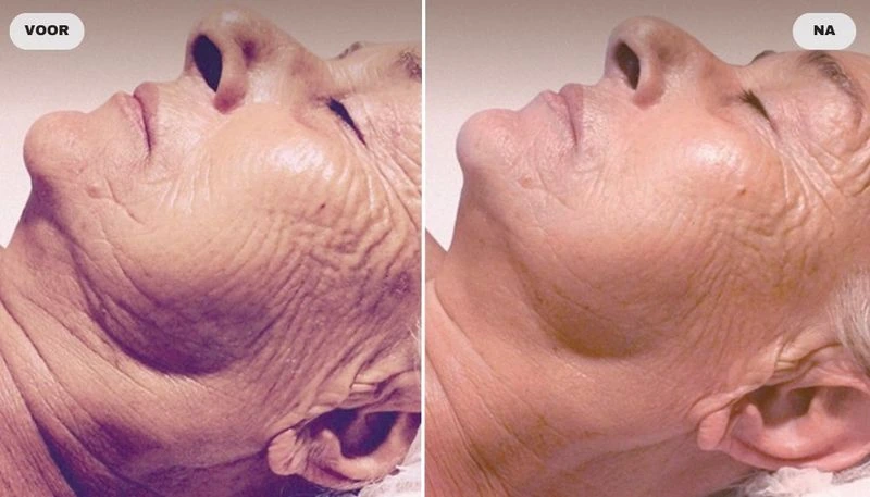 Before and after photo of neck and jawline with RF skin tightening, before left and after right