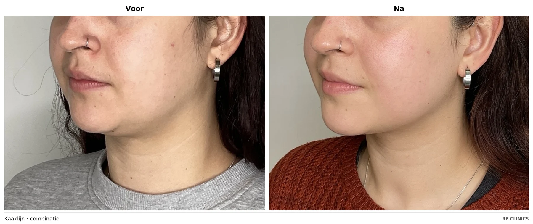 Before and after photo of the jawline after combined microneedling, RF skin tightening and fat freezing, before left and after right