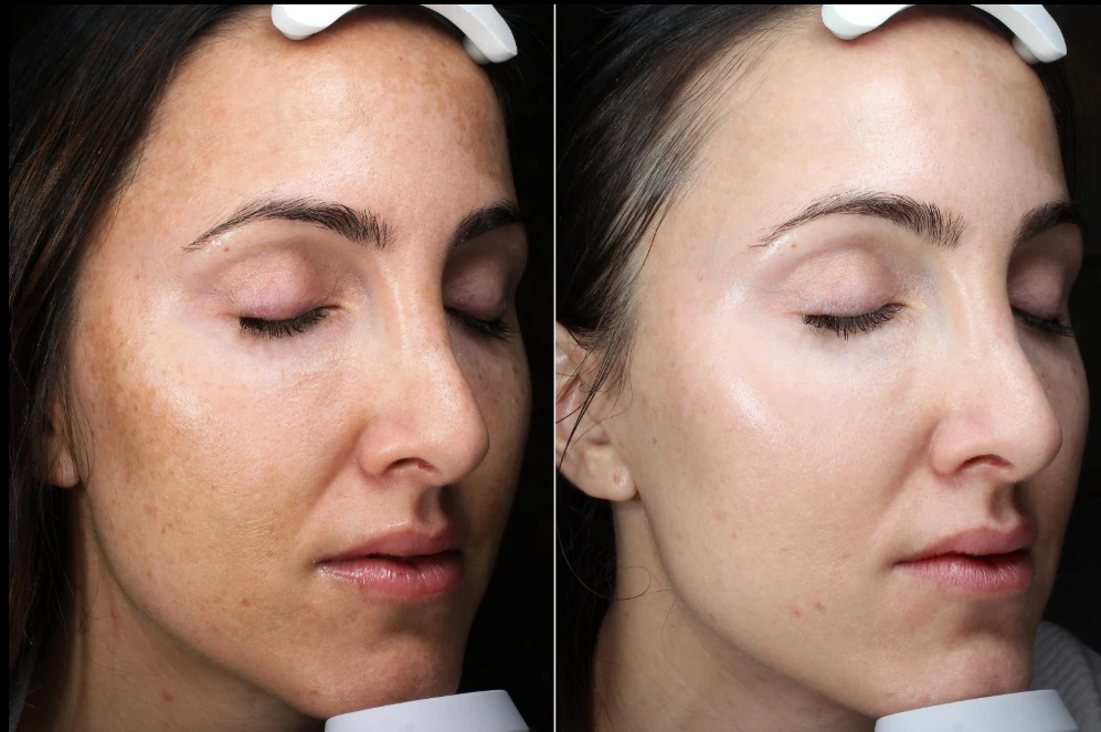 Before and after: Pigmentation treatment 03 | RB Clinics
