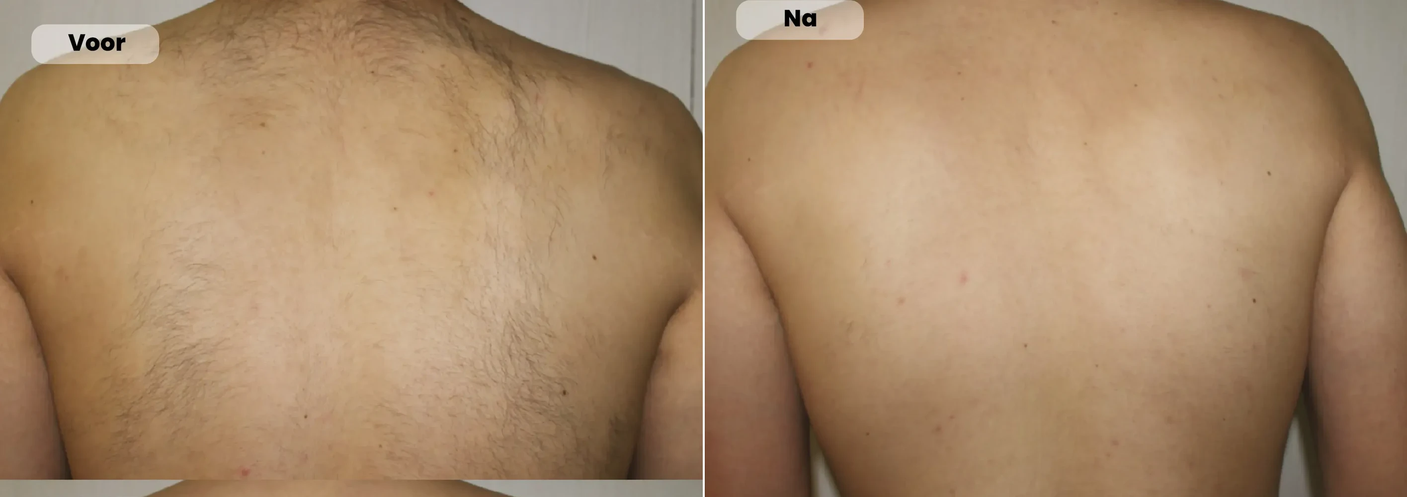 Before / After: Back, Laser hair removal | RB Clinics