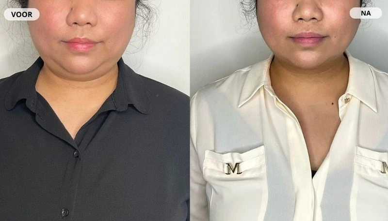 Before and after result from fat freezing at RB Clinics