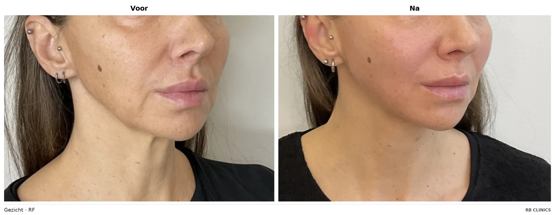 Before and after photo of face with RF skin tightening, before left and after right