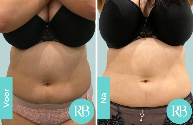 Before and after result from fat freezing at RB Clinics