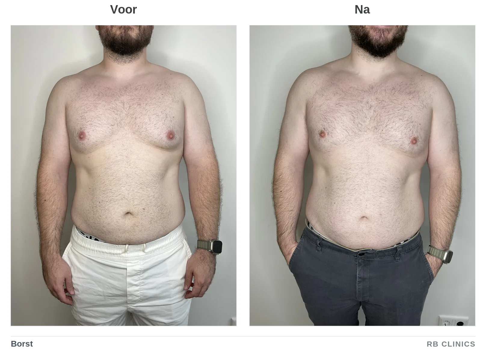 Voor- en nafoto van de borst bij vet bevriezen, voor links en na rechts