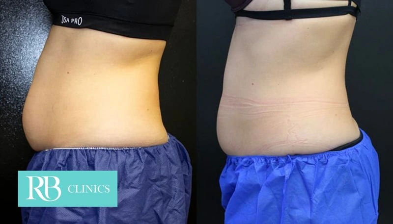 Before and after result from fat freezing at RB Clinics