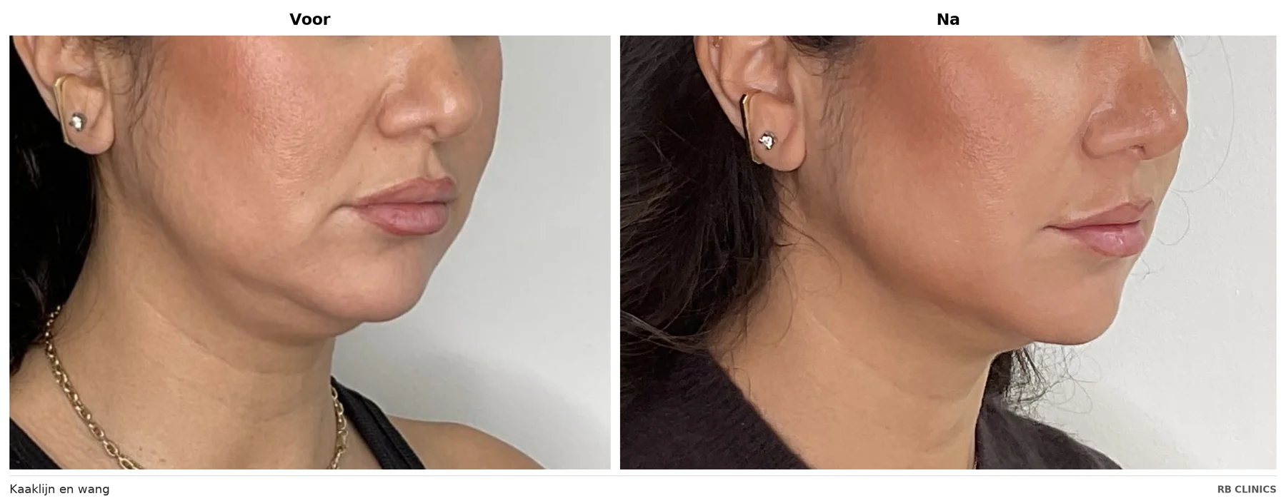 Before and after photo of jawline and cheek with RF skin tightening, before left and after right
