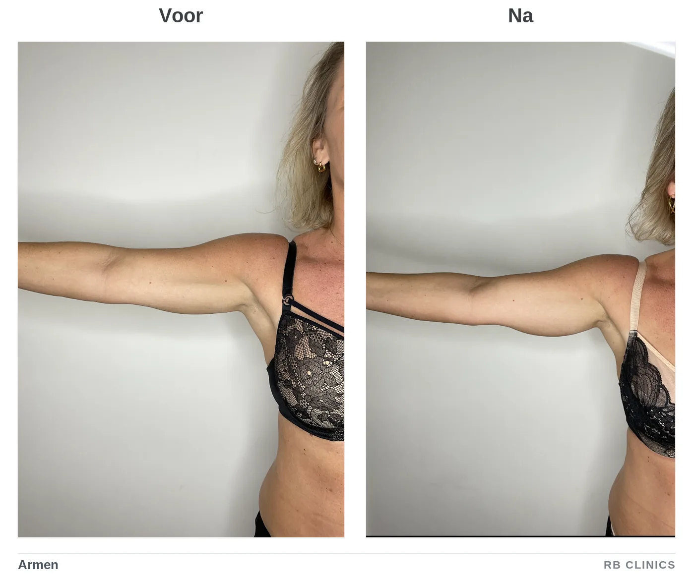 Voor- en nafoto van de armen bij vet bevriezen, voor links en na rechts