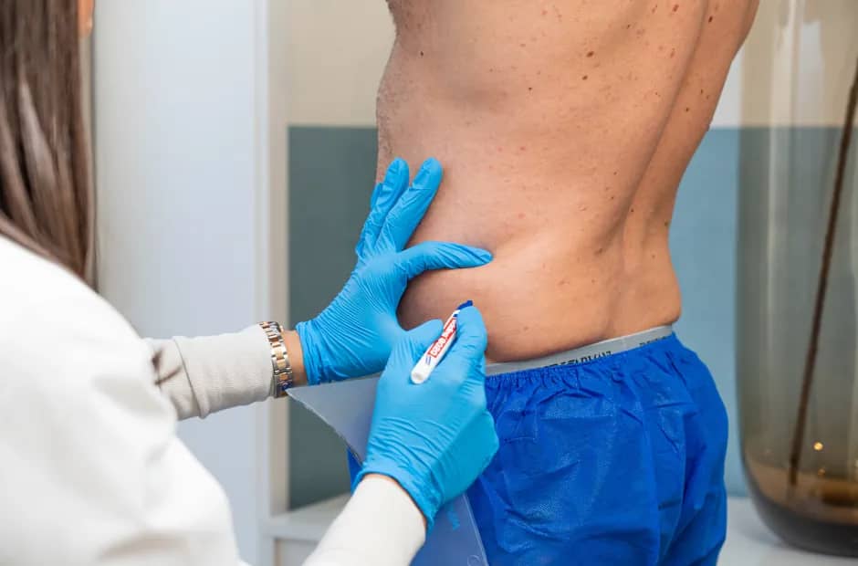 RB Clinics-specialist beoordeelt het heupvet voor cryolipolyse