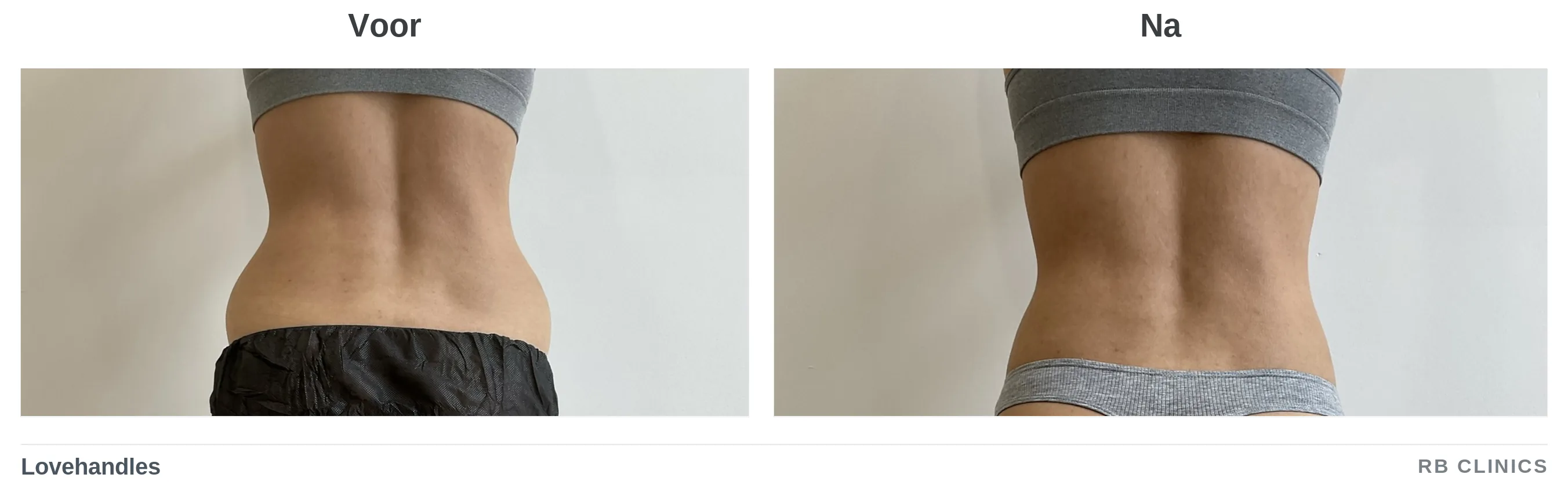 Voor- en nafoto van de lovehandles bij vet bevriezen, voor links en na rechts