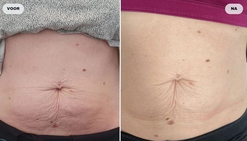 Before and after photo of abdomen with RF skin tightening, before left and after right