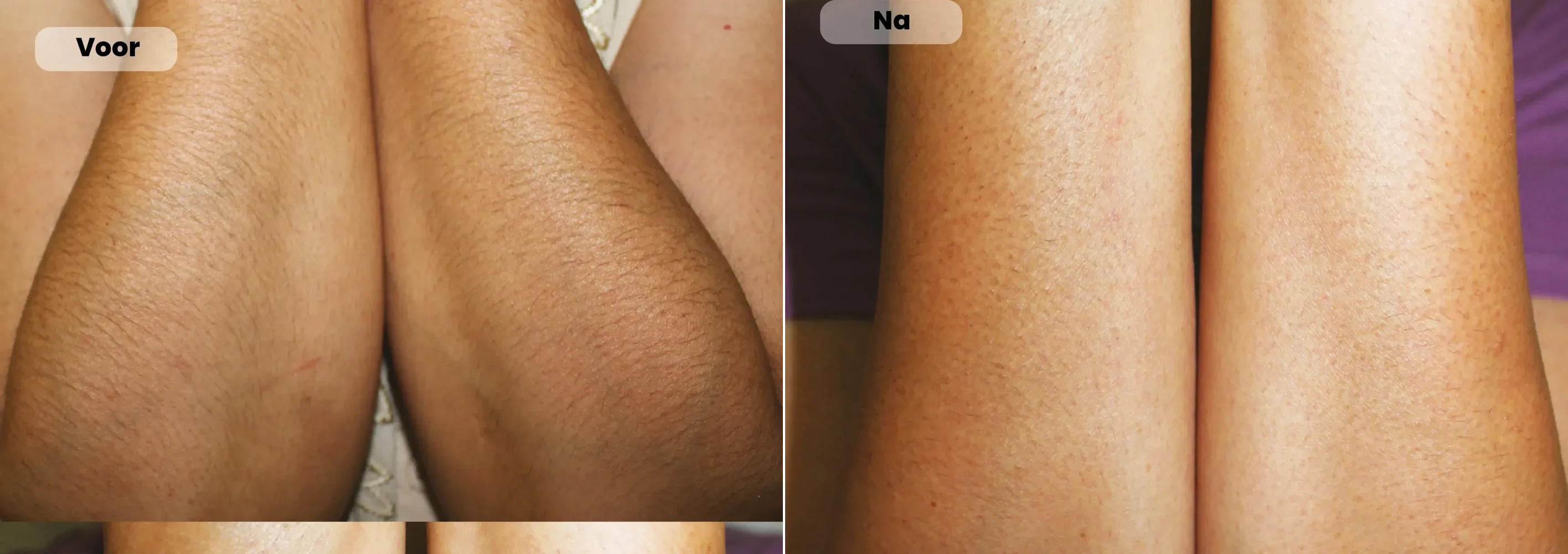 Before / After: Legs, Laser hair removal | RB Clinics