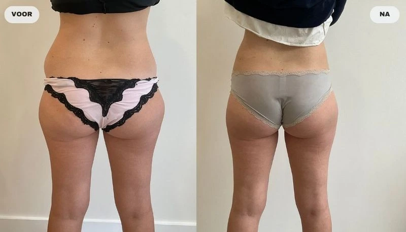 Before and after result from fat freezing at RB Clinics