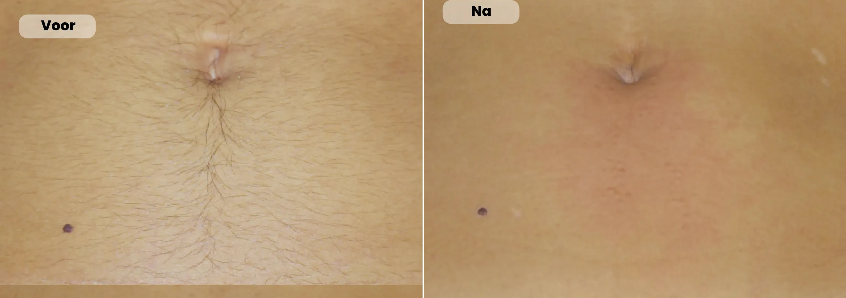 Before / After: Abdomen, Laser hair removal | RB Clinics