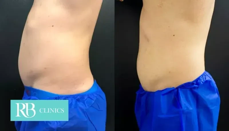 Before and after result from fat freezing at RB Clinics