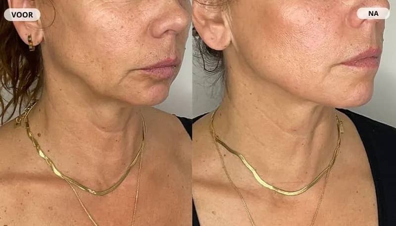 Voor en na resultaat van een microneedling behandeling bij RB Clinics: hals en kaaklijn