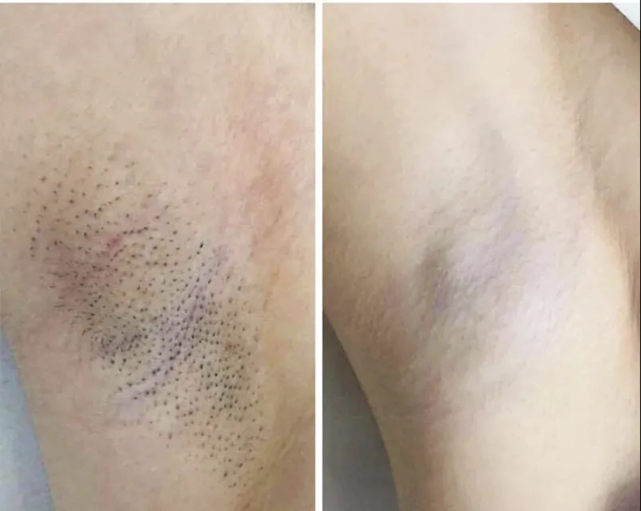 Before / After: Underarms, Laser hair removal | RB Clinics