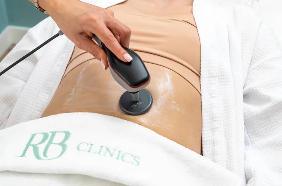Huidverstrakkingsbehandeling van de buik met Indiba bij RB Clinics