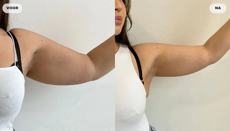 Before and after result from fat freezing at RB Clinics
