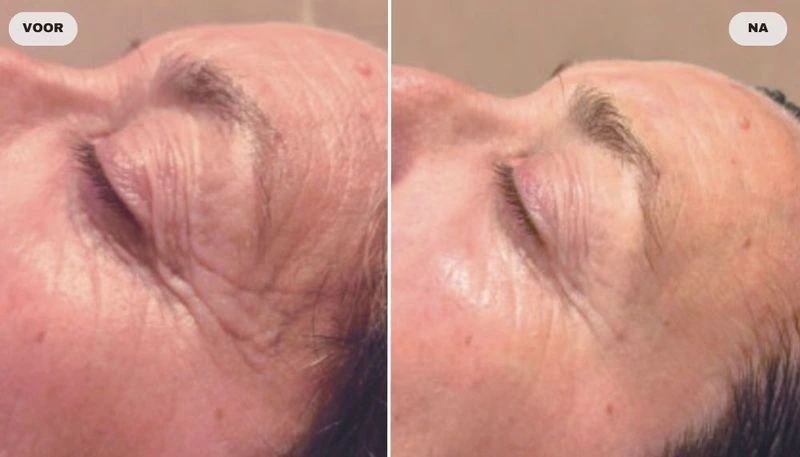 Before and after photo of eyelids with RF skin tightening, before left and after right