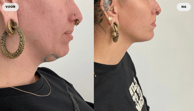 Before and after result from fat freezing at RB Clinics