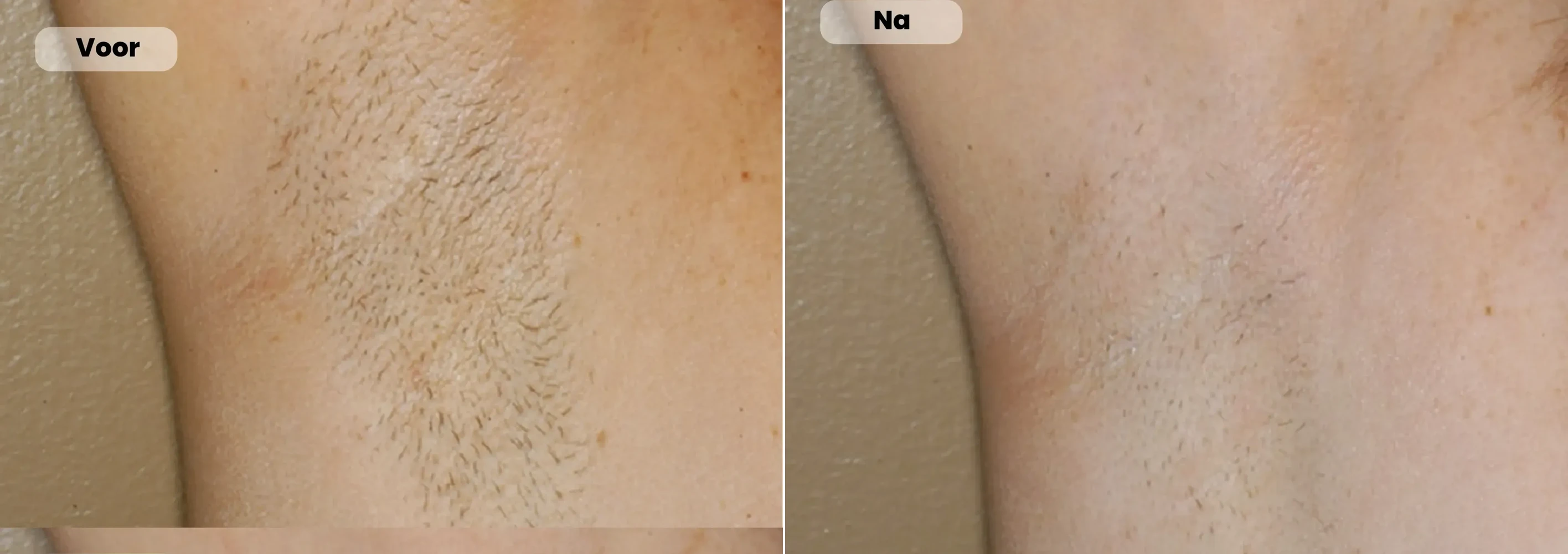 Before / After: Underarms, Laser hair removal | RB Clinics