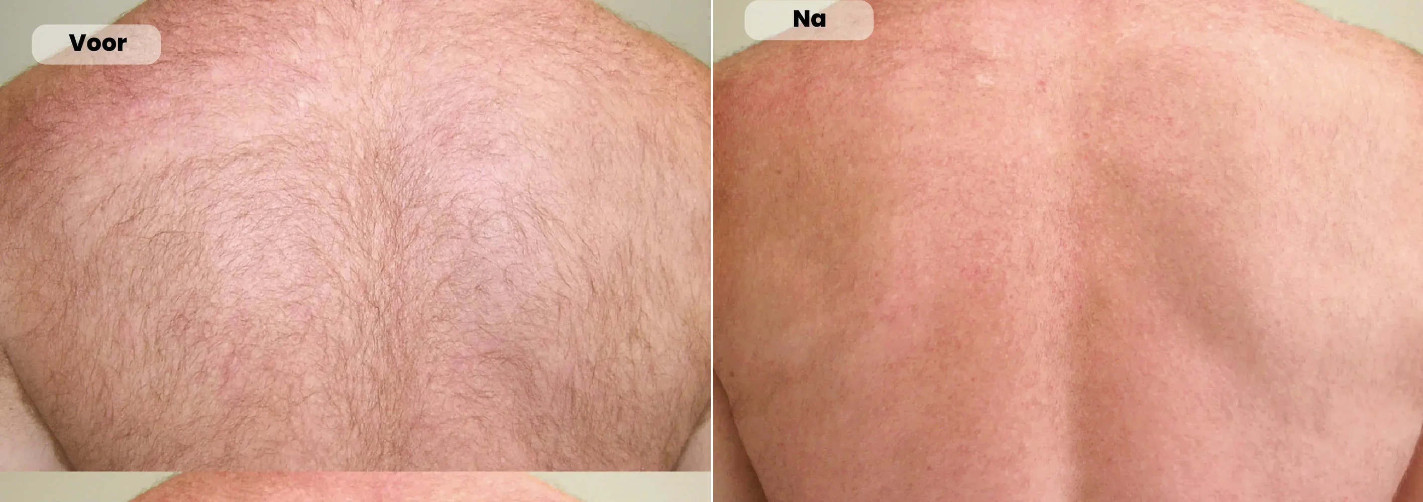 Before / After: Back, Laser hair removal | RB Clinics