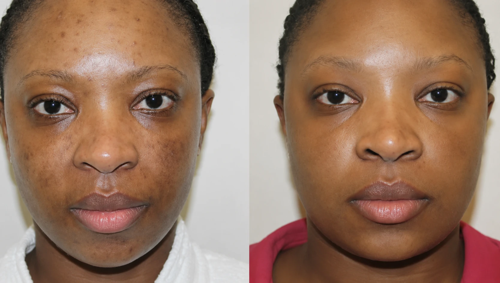 Before and after: Pigmentation treatment 04 | RB Clinics