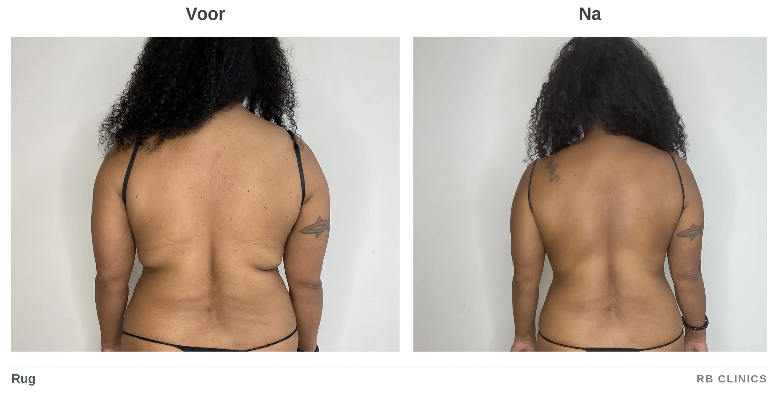 Voor- en nafoto van de rug bij vet bevriezen, voor links en na rechts