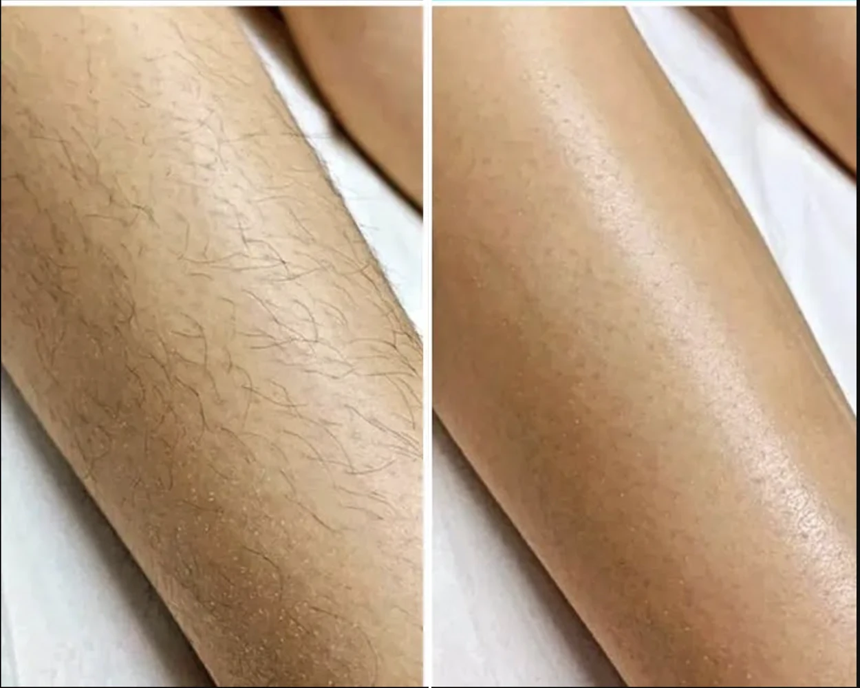 Before / After: Legs, Laser hair removal | RB Clinics
