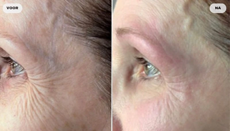 Before and after photo of eye corner with RF skin tightening, before left and after right