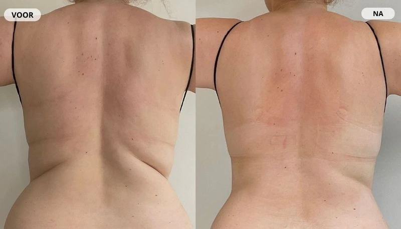 Before and after result from fat freezing at RB Clinics