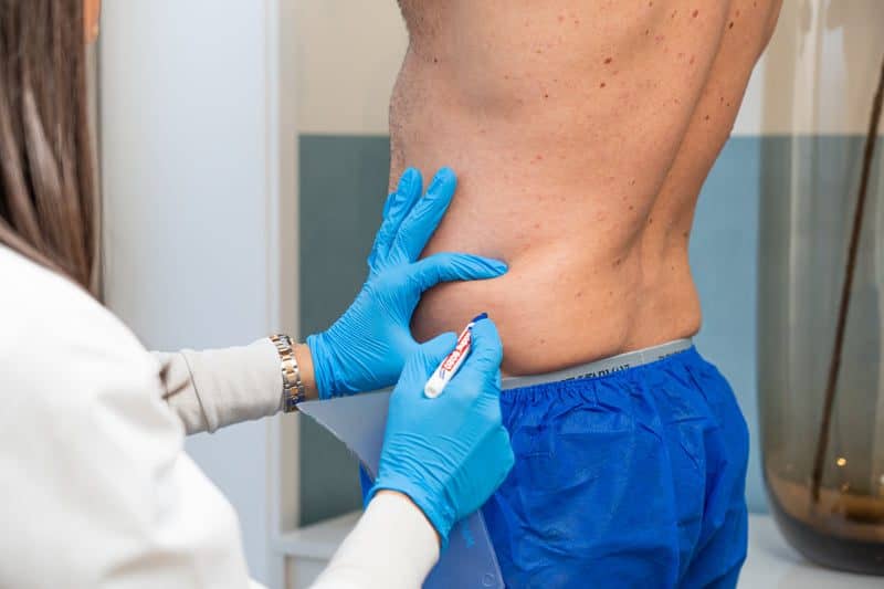 Is vet bevriezen permanent? | RB Clinics Amsterdam