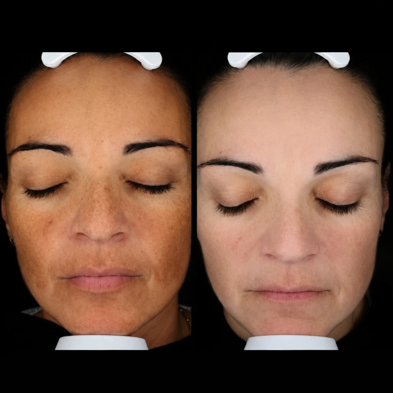 Before and after: Pigmentation treatment 05 | RB Clinics