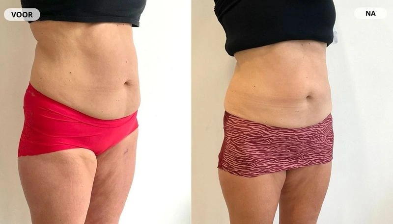 Before and after result from fat freezing at RB Clinics
