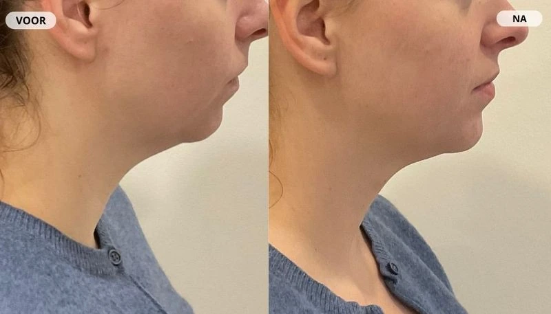 Before and after result from fat freezing at RB Clinics