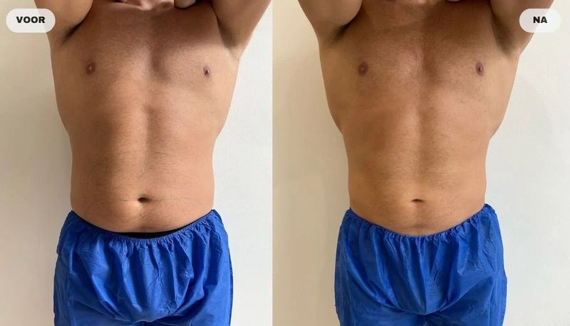 Before and after result from fat freezing at RB Clinics